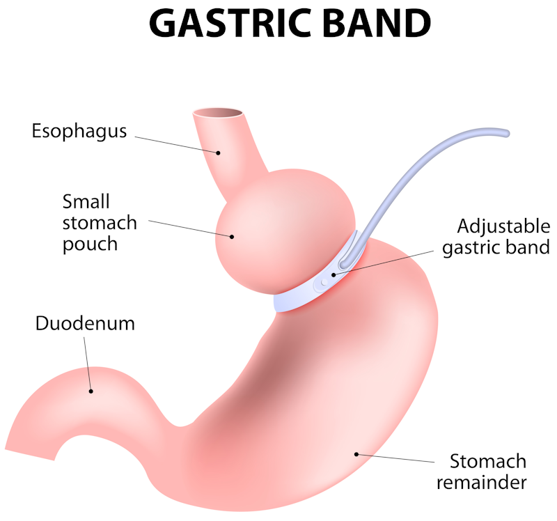 Gastric Band